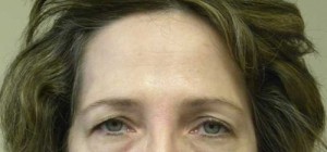 Brow Lift/Forehead Rejuvenation Case 6452 Before Photo Brow Lift/Forehead Rejuvenation