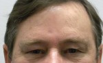 Brow Lift/Forehead Rejuvenation