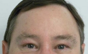 Brow Lift/Forehead Rejuvenation