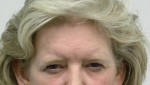 Brow Lift/Forehead Rejuvenation