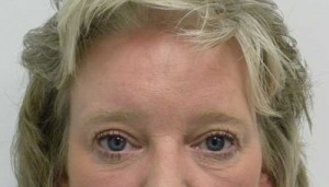 Brow Lift/Forehead Rejuvenation Case 6458 After Photo Brow Lift/Forehead Rejuvenation