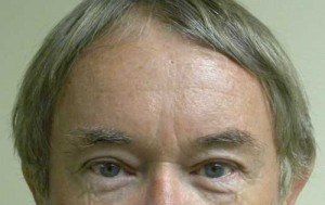 Brow Lift/Forehead Rejuvenation Case 6461 After Photo Brow Lift/Forehead Rejuvenation