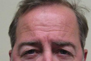 Brow Lift/Forehead Rejuvenation Case 6464 Before Photo Brow Lift/Forehead Rejuvenation