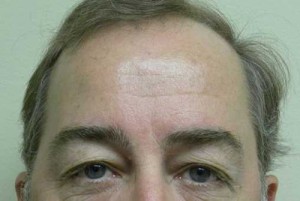 Brow Lift/Forehead Rejuvenation Case 6464 After Photo Brow Lift/Forehead Rejuvenation
