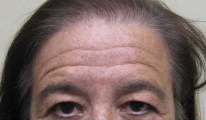 Brow Lift/Forehead Rejuvenation Case 6467 Before Photo Brow Lift/Forehead Rejuvenation
