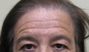 Brow Lift/Forehead Rejuvenation