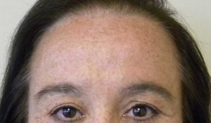 Brow Lift/Forehead Rejuvenation Case 6467 After Photo Brow Lift/Forehead Rejuvenation