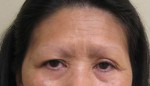 Brow Lift/Forehead Rejuvenation