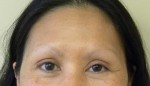 Brow Lift/Forehead Rejuvenation
