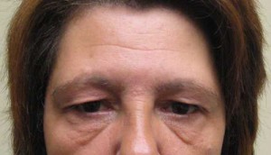 Brow Lift/Forehead Rejuvenation Case 6473 Before Photo Brow Lift/Forehead Rejuvenation