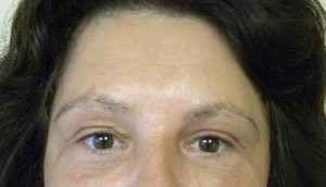 Brow Lift/Forehead Rejuvenation Case 6473 After Photo Brow Lift/Forehead Rejuvenation