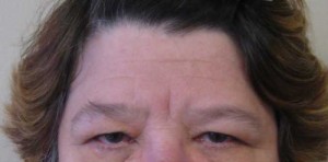 Brow Lift/Forehead Rejuvenation Case 6476 Before Photo Brow Lift/Forehead Rejuvenation
