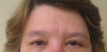 Brow Lift/Forehead Rejuvenation