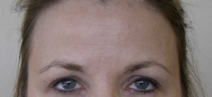 Brow Lift/Forehead Rejuvenation Case 6479 Before Photo Brow Lift/Forehead Rejuvenation
