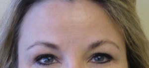Brow Lift/Forehead Rejuvenation Case 6479 After Photo Brow Lift/Forehead Rejuvenation