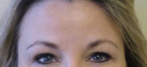 Brow Lift/Forehead Rejuvenation