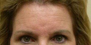 Brow Lift/Forehead Rejuvenation Case 6482 Before Photo Brow Lift/Forehead Rejuvenation
