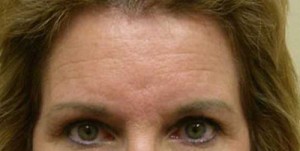 Brow Lift/Forehead Rejuvenation