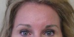 Brow Lift/Forehead Rejuvenation