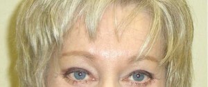 Brow Lift/Forehead Rejuvenation Case 6485 After Photo Brow Lift/Forehead Rejuvenation