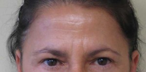 Brow Lift/Forehead Rejuvenation