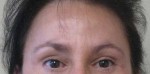 Brow Lift/Forehead Rejuvenation