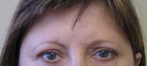 Brow Lift/Forehead Rejuvenation Case 6491 Before Photo Brow Lift/Forehead Rejuvenation
