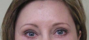 Brow Lift/Forehead Rejuvenation Case 6491 After Photo Brow Lift/Forehead Rejuvenation