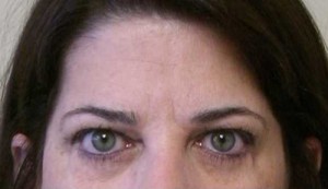 Brow Lift/Forehead Rejuvenation Case 6494 Before Photo Brow Lift/Forehead Rejuvenation