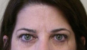 Brow Lift/Forehead Rejuvenation