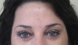 Brow Lift/Forehead Rejuvenation Case 6494 After Photo Brow Lift/Forehead Rejuvenation