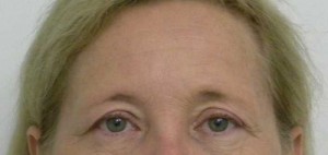 Brow Lift/Forehead Rejuvenation Case 6497 Before Photo Brow Lift/Forehead Rejuvenation