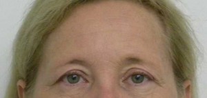 Brow Lift/Forehead Rejuvenation