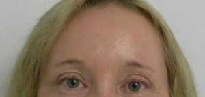 Brow Lift/Forehead Rejuvenation Case 6497 After Photo Brow Lift/Forehead Rejuvenation