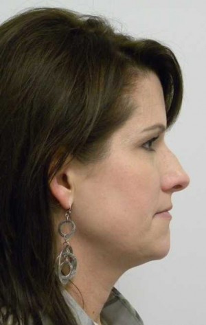 Rhinoplasty/Nose Reshaping Case 6500 Before Photo Rhinoplasty/Nose Reshaping