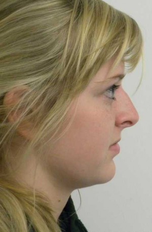 Rhinoplasty/Nose Reshaping