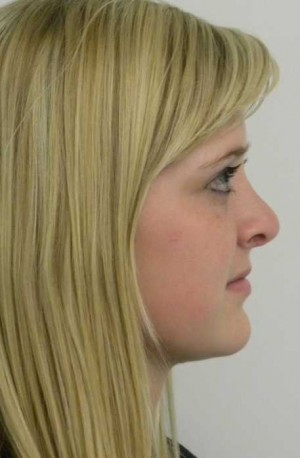 Rhinoplasty/Nose Reshaping