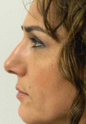 Rhinoplasty/Nose Reshaping