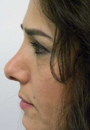 Rhinoplasty/Nose Reshaping