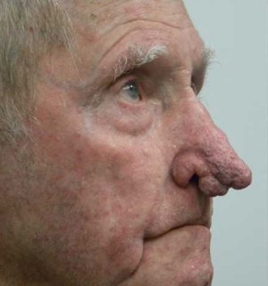 Rhinoplasty/Nose Reshaping