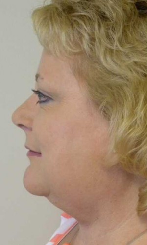 Rhinoplasty/Nose Reshaping Case 6526 After Photo Rhinoplasty/Nose Reshaping