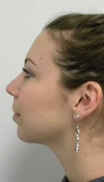 Facial Implants