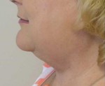 Facial Implants