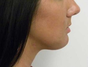Facial Implants Case 6552 After Photo Facial Implants
