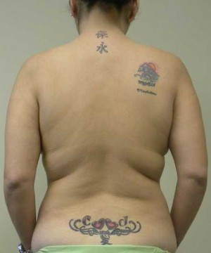 Liposuction Case 7300 Before Photo Liposuction