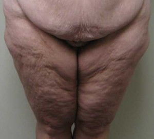 Thigh Lift Case 7279 Before Photo Thigh Lift