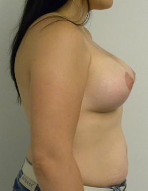 Breast Augmentation Case 8403 After Photo Breast Augmentation