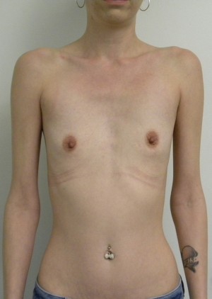 Breast Augmentation Case 8410 Before Photo Breast Augmentation