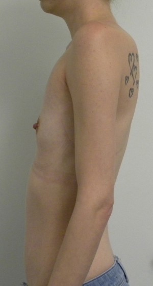 Breast Augmentation Case 8410 Before Photo Breast Augmentation