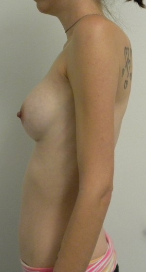 Breast Augmentation Case 8410 After Photo Breast Augmentation